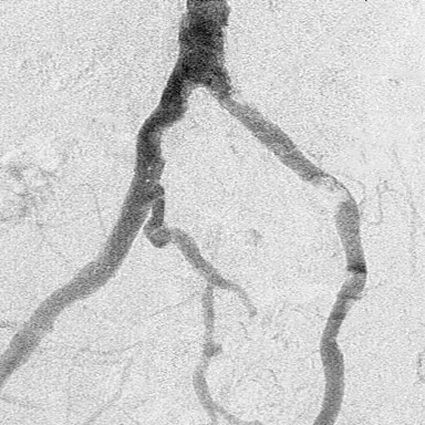 Pelvic-iliac angiogram from the segmentation benchmark, test image 196