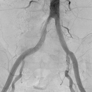 Pelvic-iliac angiogram from the segmentation benchmark, test image 333